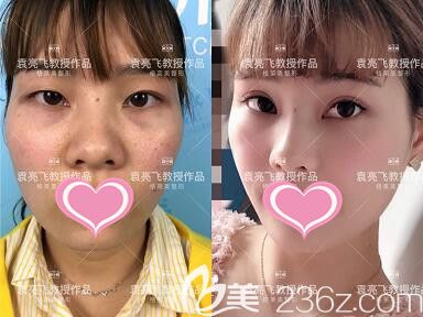 袁亮飛眼綜合真人前后效果對比照片