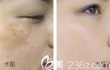 包頭葉子蘇明山祛斑效果怎么樣 包頭葉子蘇明山祛斑效果怎么樣