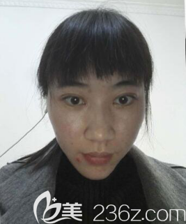 術(shù)前的我 術(shù)前的我