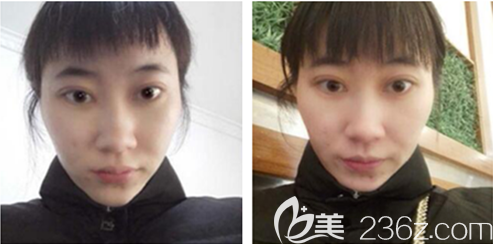 李正鵬激光祛斑術(shù)后一周 李正鵬激光祛斑術(shù)后一周