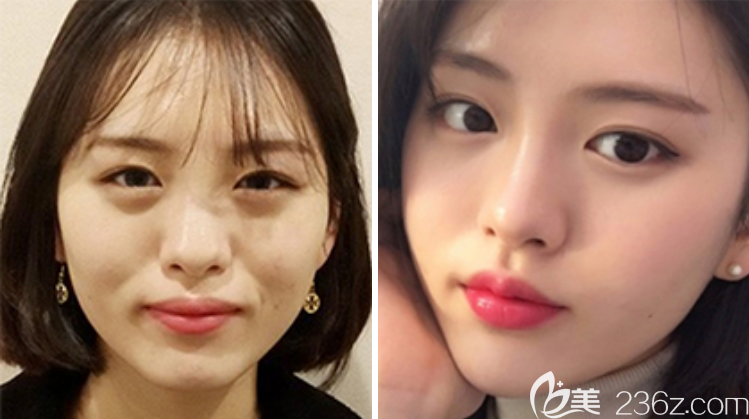 韓國Star21整形外科醫(yī)院自體脂肪面部填充半年效果對比 韓國Star21整形外科醫(yī)院自體脂肪面部填充半年效果對比