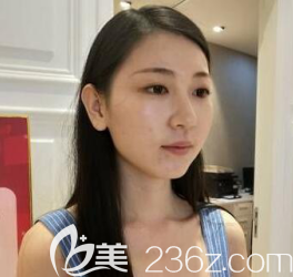 我術(shù)前臉肉挺多的 我術(shù)前臉肉挺多的