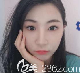 遵義韓美取頰脂墊術(shù)后2個(gè)月 遵義韓美取頰脂墊術(shù)后2個(gè)月