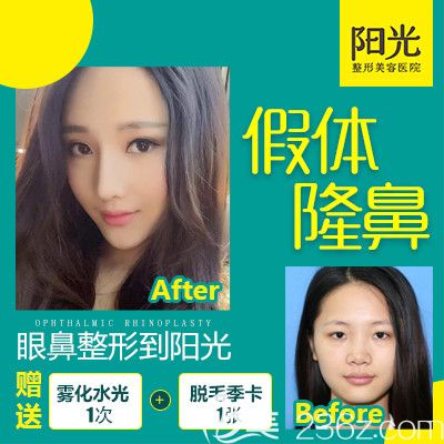 整形醫(yī)院陳群院長(zhǎng)隆鼻案例 整形醫(yī)院陳群院長(zhǎng)隆鼻案例