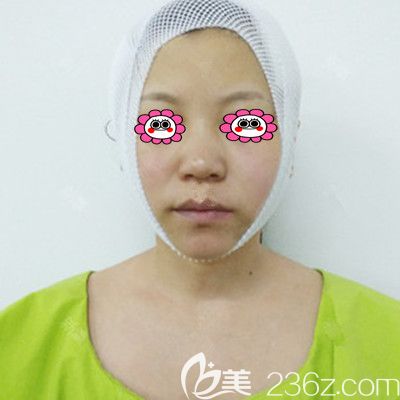 剛做完面部<span style= 剛做完面部<span style=