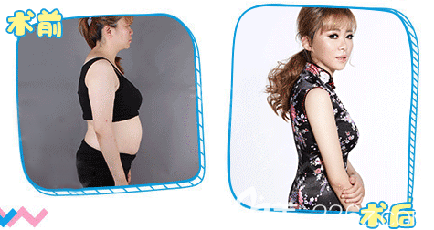 整形醫(yī)院吸脂案例 整形醫(yī)院吸脂案例