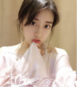 于建濤瘦臉和假體墊下巴術(shù)后2個月