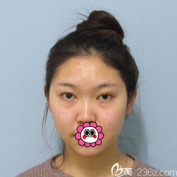 哈爾濱索菲硅膠墊下巴前 哈爾濱索菲硅膠墊下巴前