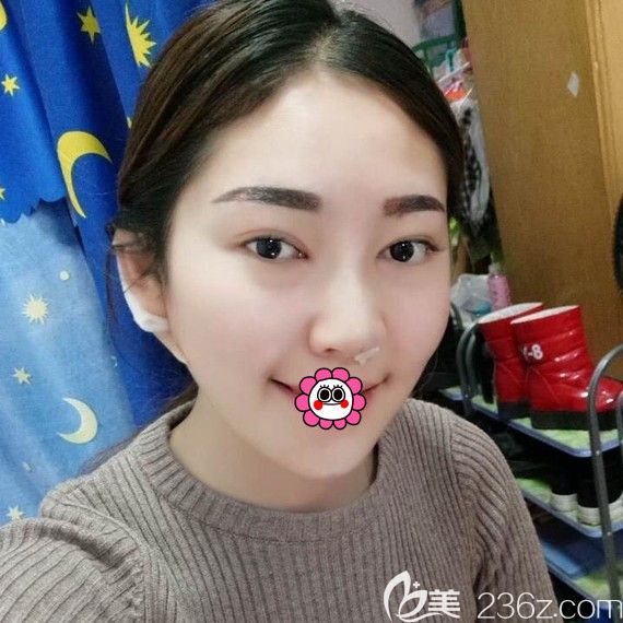 硅膠墊下巴一周拆線后效果 硅膠墊下巴一周拆線后效果