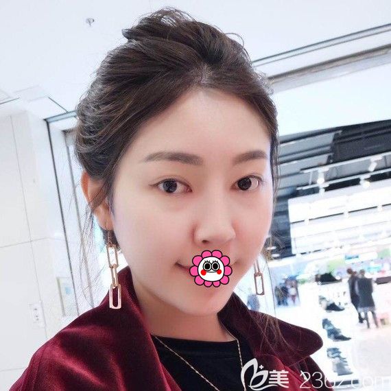 哈爾濱索菲硅膠隆下巴一個月效果 哈爾濱索菲硅膠隆下巴一個月效果