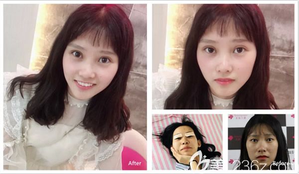 俞靜醫(yī)生雙眼皮修復案例展示 俞靜醫(yī)生雙眼皮修復案例展示