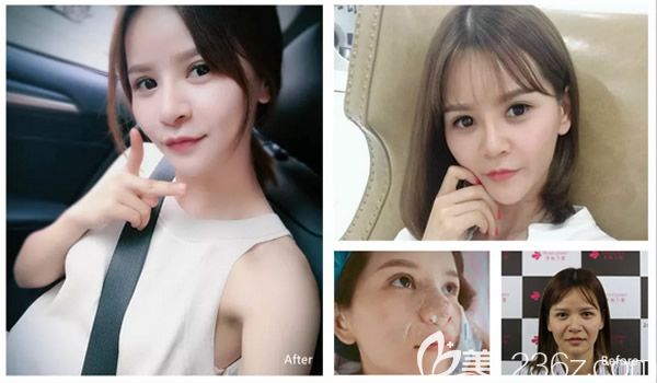 俞靜醫(yī)生假體隆鼻修復案例對比 俞靜醫(yī)生假體隆鼻修復案例對比