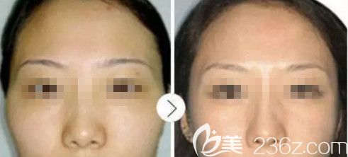 衡水唯美注射玻尿酸豐太陽穴案例 衡水唯美注射玻尿酸豐太陽穴案例