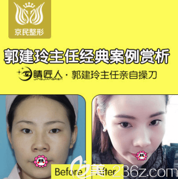 北京京民郭建玲醫(yī)生韓式無(wú)痕雙眼皮+開眼角案例