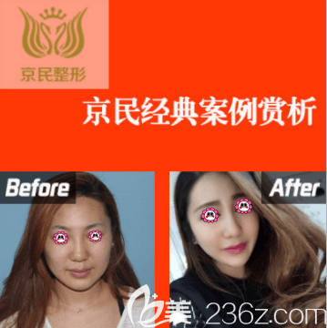 北京京民解玉萍醫(yī)生光子嫩膚案例