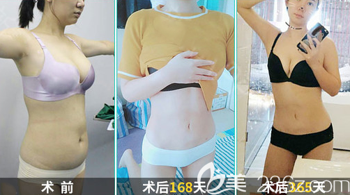 成都艾米麗程紅濤腰腹吸脂術(shù)后效果圖