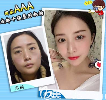 成都艾米麗程洪濤自體脂肪面部填充案例效果圖