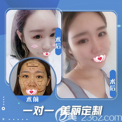 石家莊藍(lán)山自體脂肪填充面部案例