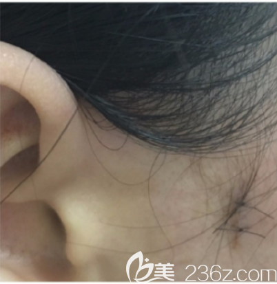 說一說我在韓國本愛整形找文圣昊做顴弓內(nèi)推的經(jīng)歷吧