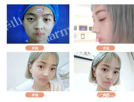 鄭州醫(yī)德佳胡斌眼綜合案例