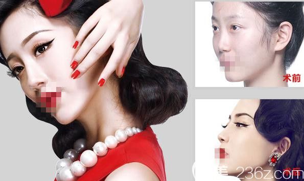 鄭州醫(yī)德佳整形醫(yī)院 鼻綜合前后對比
