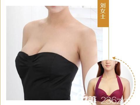 鄭州醫(yī)德佳自體脂肪豐胸前后對比