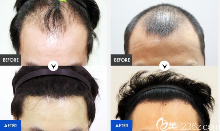 韓國forhair植發(fā)醫(yī)院男士植發(fā)案例效果對比圖