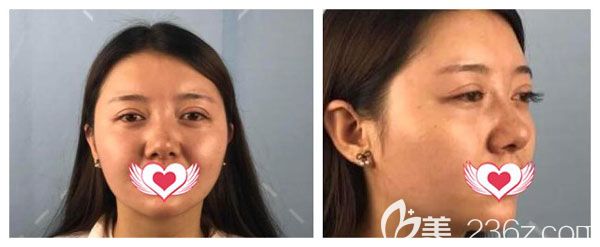 在昆明夢想做雙眼皮失敗修復(fù)前 在昆明夢想做雙眼皮失敗修復(fù)前
