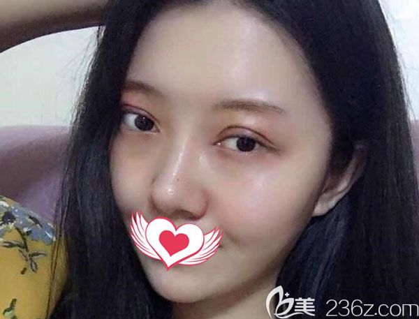 全切雙眼皮第7天眼周的淤青已經(jīng)慢慢變黃 全切雙眼皮第7天眼周的淤青已經(jīng)慢慢變黃