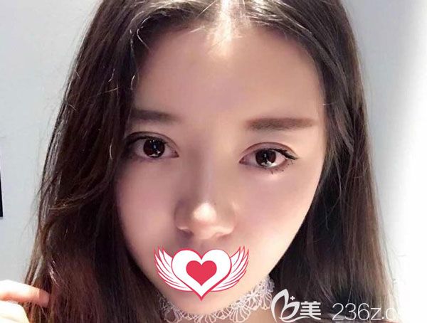 雙眼皮修復(fù)手術(shù)20天形態(tài)看起來非常自然 雙眼皮修復(fù)手術(shù)20天形態(tài)看起來非常自然