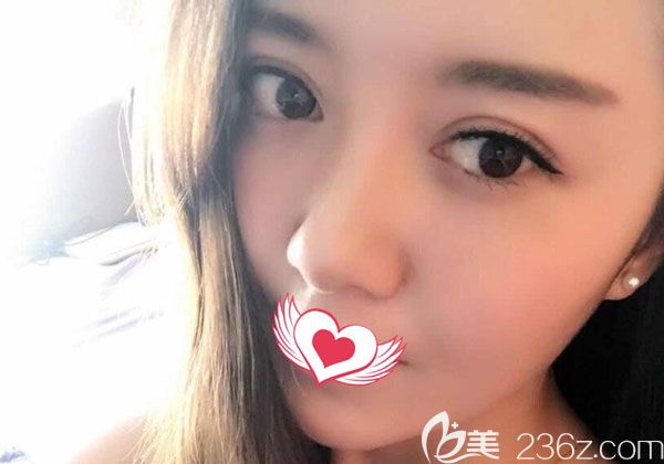 全切雙眼皮修復(fù)1個月基本已經(jīng)定型 全切雙眼皮修復(fù)1個月基本已經(jīng)定型