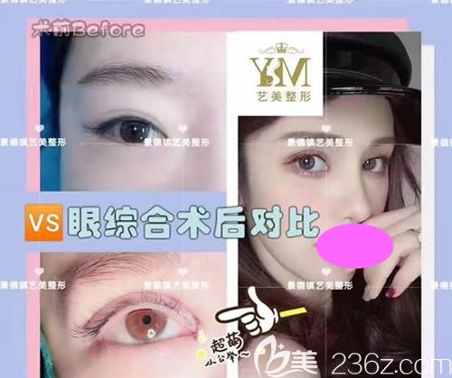 景德鎮(zhèn)藝美整形虞國(guó)鋒主任做的全切雙眼皮+開眼角案例效果 景德鎮(zhèn)藝美整形虞國(guó)鋒主任做的全切雙眼皮+開眼角案例效果