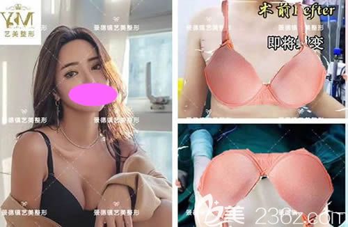 景德鎮(zhèn)藝美整形虞國(guó)鋒主任做的曼托假體隆胸案例效果 景德鎮(zhèn)藝美整形虞國(guó)鋒主任做的曼托假體隆胸案例效果