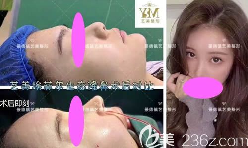 景德鎮(zhèn)藝美整形虞國(guó)鋒主任做的假體+肋軟骨隆鼻案例效果 景德鎮(zhèn)藝美整形虞國(guó)鋒主任做的假體+肋軟骨隆鼻案例效果