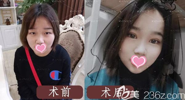 武漢壹加壹付俊俐全切雙眼皮綜合術(shù)后案例