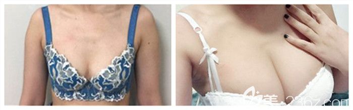 武漢壹加壹李艷東醫(yī)生假體隆胸案例