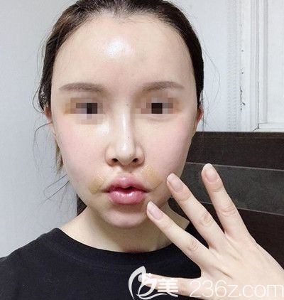 在韓國EU做面部輪廓手術后7天 在韓國EU做面部輪廓手術后7天