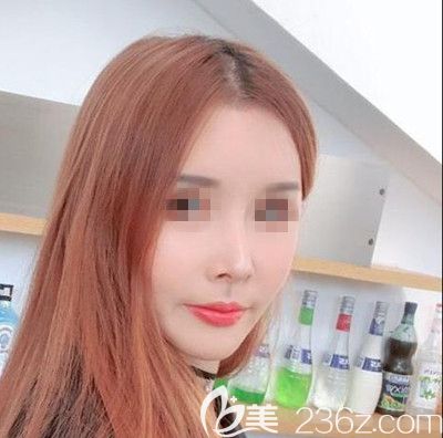 在韓國EU頜面輪廓整形外科做了輪廓三件套效果改善了我的高顴骨