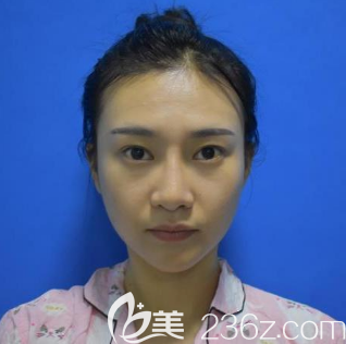 在深圳南雅做雙眼皮和填充前的照片 在深圳南雅做雙眼皮和填充前的照片