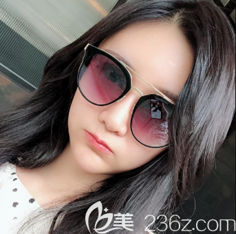 雙眼皮脂肪填充術(shù)后5天恢復(fù)效果 雙眼皮脂肪填充術(shù)后5天恢復(fù)效果