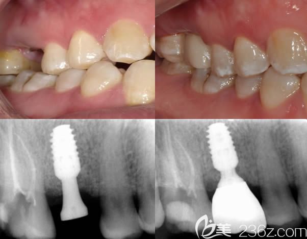 北京牙管家口腔<!--<i data=20240703-sp></i>-->波美學種植案例效果前后對比圖 北京牙管家口腔<!--<i data=20240703-sp></i>-->波美學種植案例效果前后對比圖