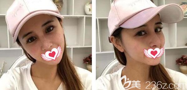 隆鼻失敗二次修復(fù)第7天腫脹不明顯