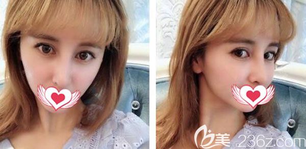 肋軟骨隆鼻一個(gè)月弧度也很自然