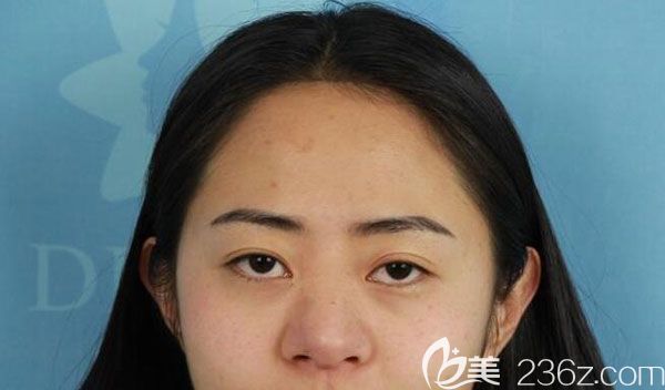 在昆明夢(mèng)想隆鼻手術(shù)前 在昆明夢(mèng)想隆鼻手術(shù)前