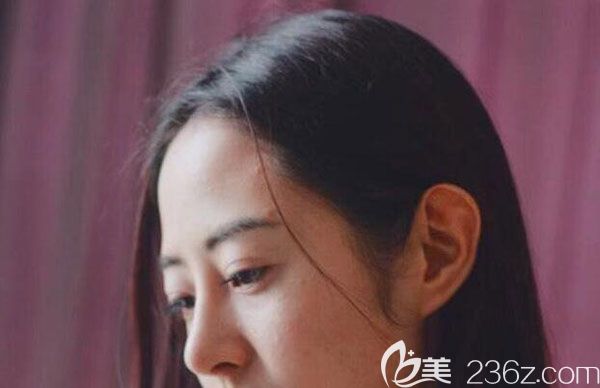 鼻綜合第7天拆線呼吸順暢多了 鼻綜合第7天拆線呼吸順暢多了