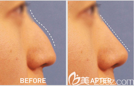 韓國(guó)lucea隆鼻手術(shù)<span style= 韓國(guó)lucea隆鼻手術(shù)<span style=