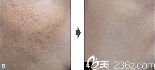 韓國lucea激光美膚案例