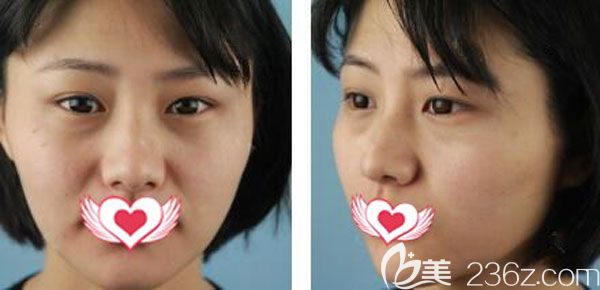 在昆明夢(mèng)想做自體脂肪面部填充前 在昆明夢(mèng)想做自體脂肪面部填充前