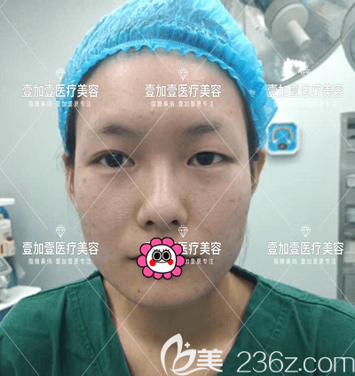 在北京壹加壹做雙眼皮修復(fù)+內(nèi)眥矯正+上瞼提肌矯正前樣子 在北京壹加壹做雙眼皮修復(fù)+內(nèi)眥矯正+上瞼提肌矯正前樣子