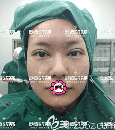 在北京壹加壹做雙眼皮修復(fù)+內(nèi)眥矯正+上瞼提肌矯正術(shù)后即刻照 在北京壹加壹做雙眼皮修復(fù)+內(nèi)眥矯正+上瞼提肌矯正術(shù)后即刻照